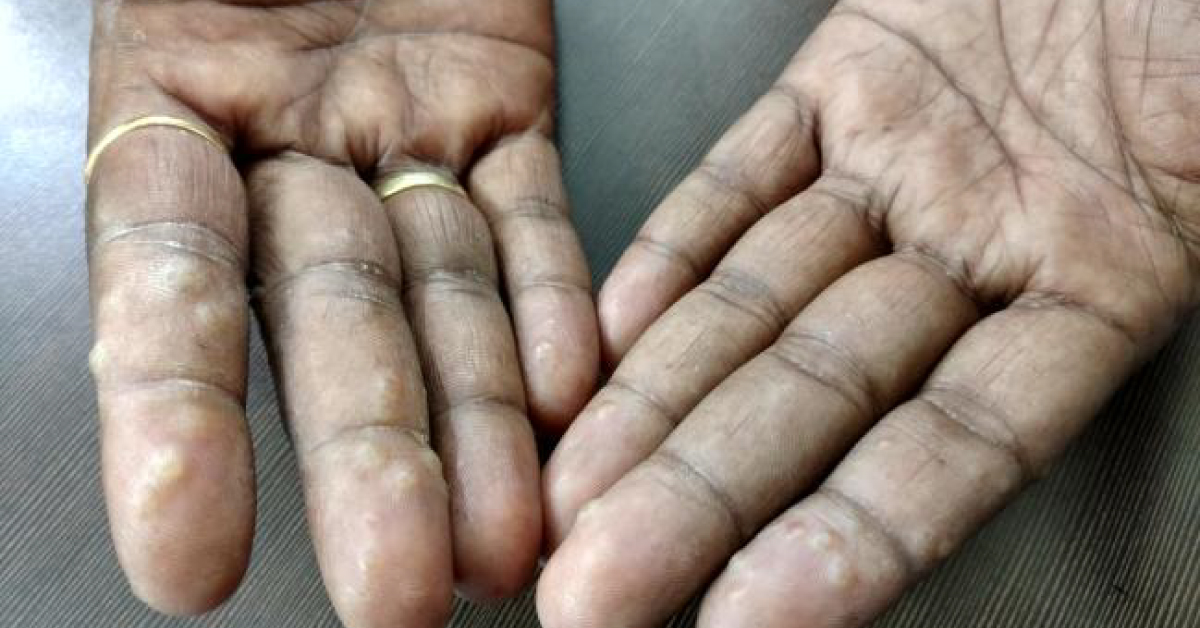 Identify The Skin Lesion