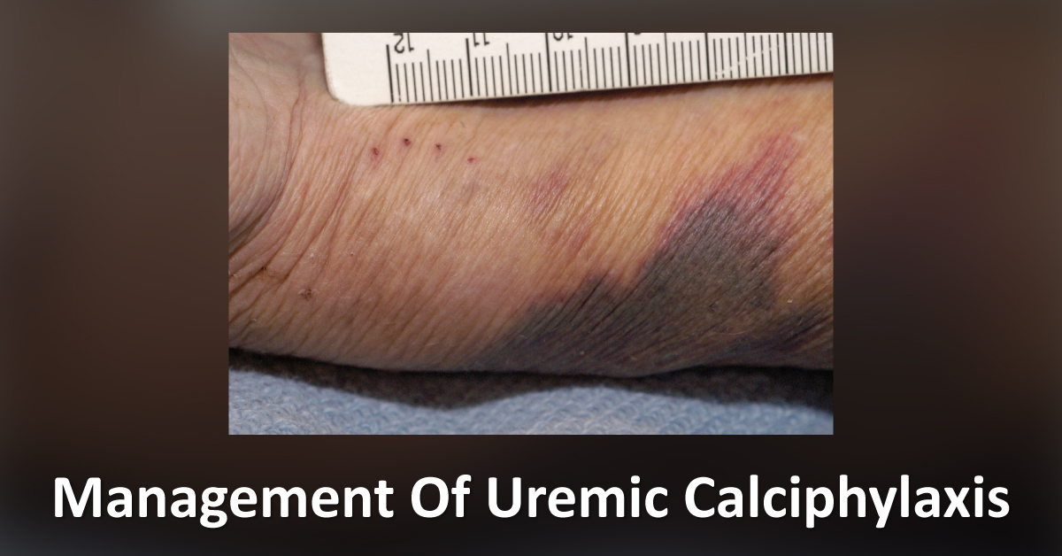 Management Of Uremic Calciphylaxis