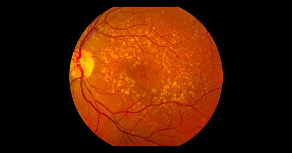 Treating Age Related Macular Degeneration