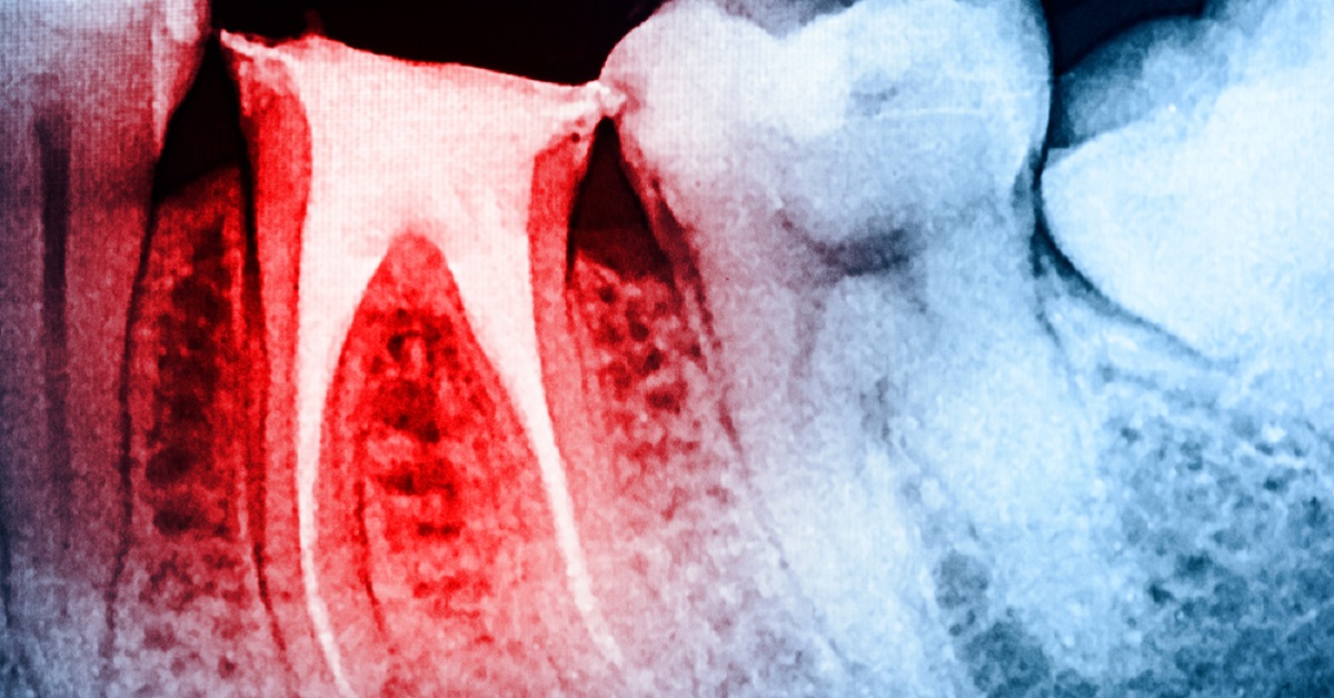 Pre-Vascularized Full-Length Dental Pulp-like Tissue Constructs for Root-Canal Treatment