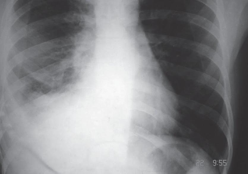 Pleural Effusion In A Young Man