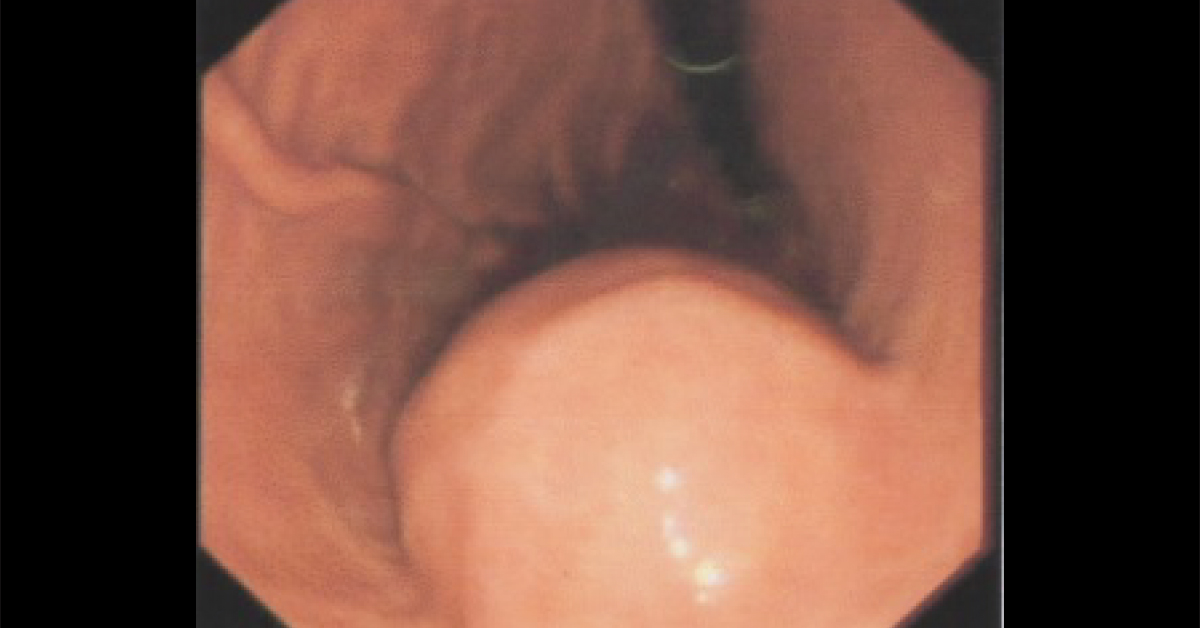Identify This Gastrointestinal Condition