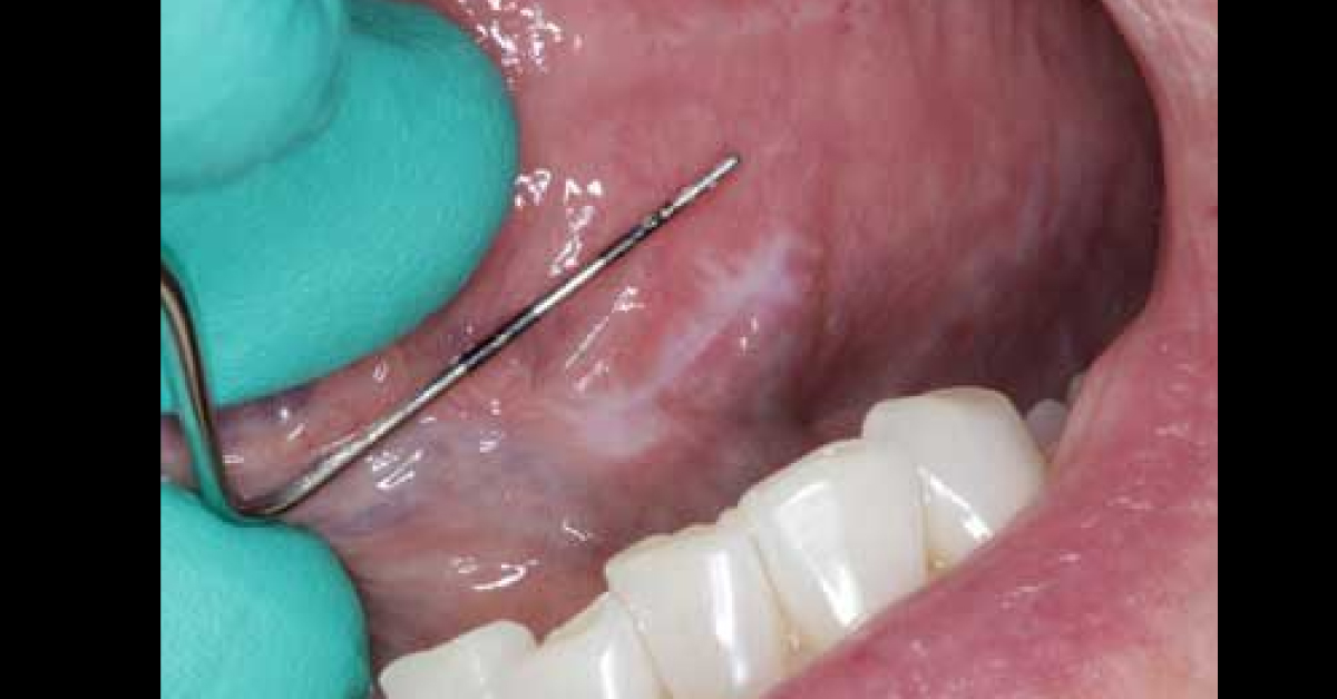 White Leukoplakic Patch On Tongue
