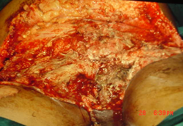How Many Free Flaps Or Microsurgical Procedures Are Safe In One Person?