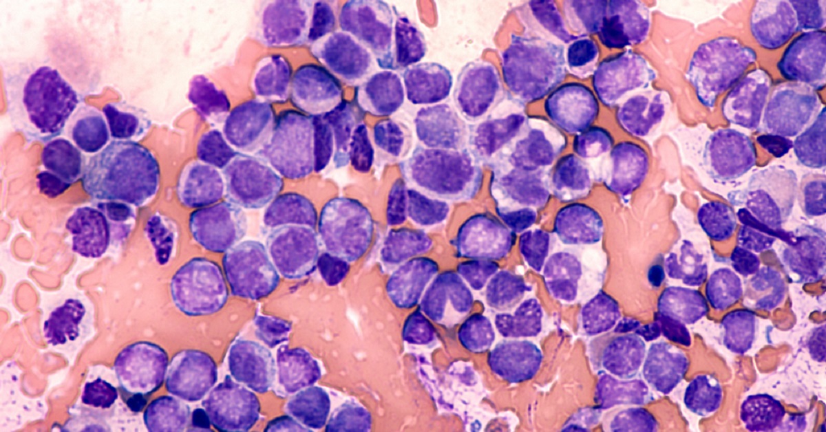 CART For Acute Lymphoblastic Leukemia In Children