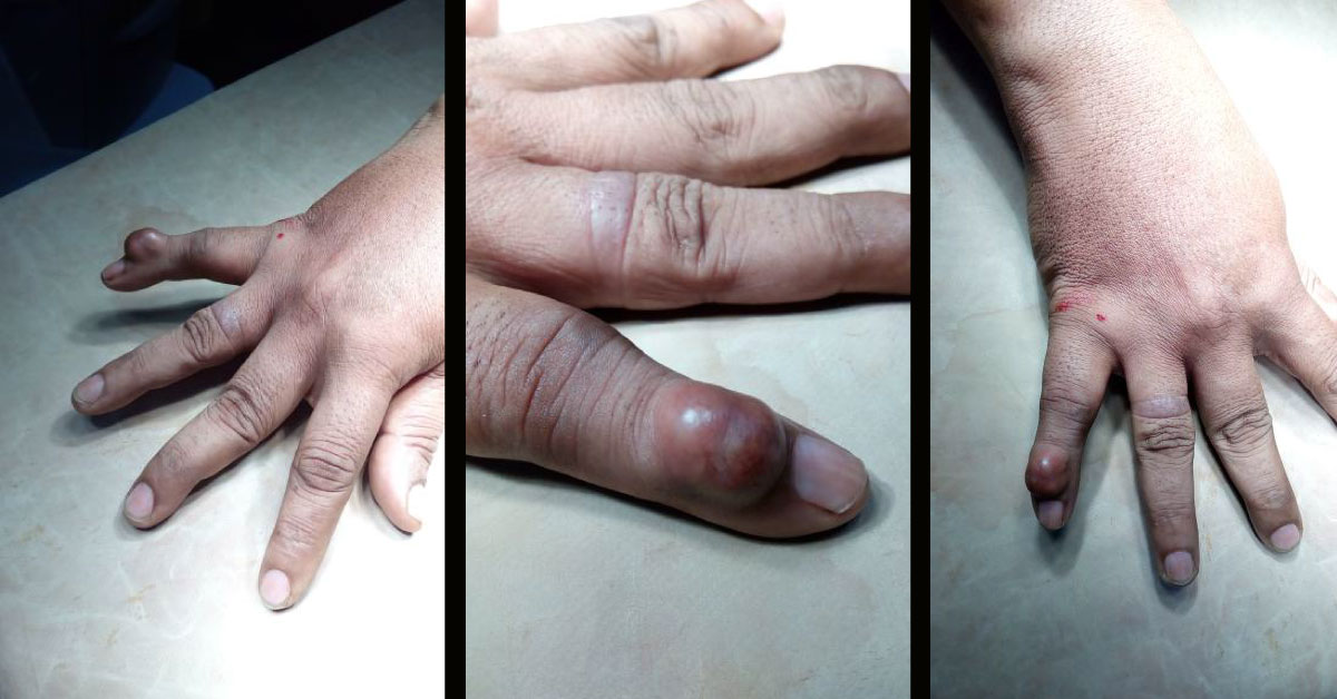 A Good Short Case For Board Examination In Orthopaedics