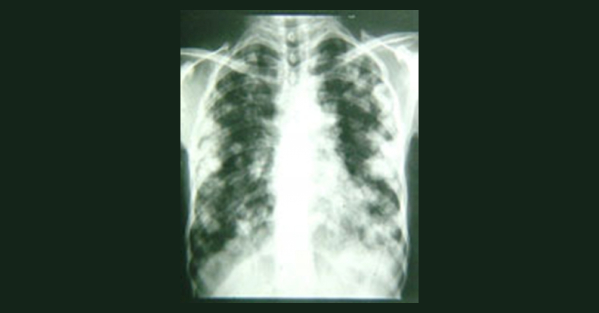 A Case of Dyspnea