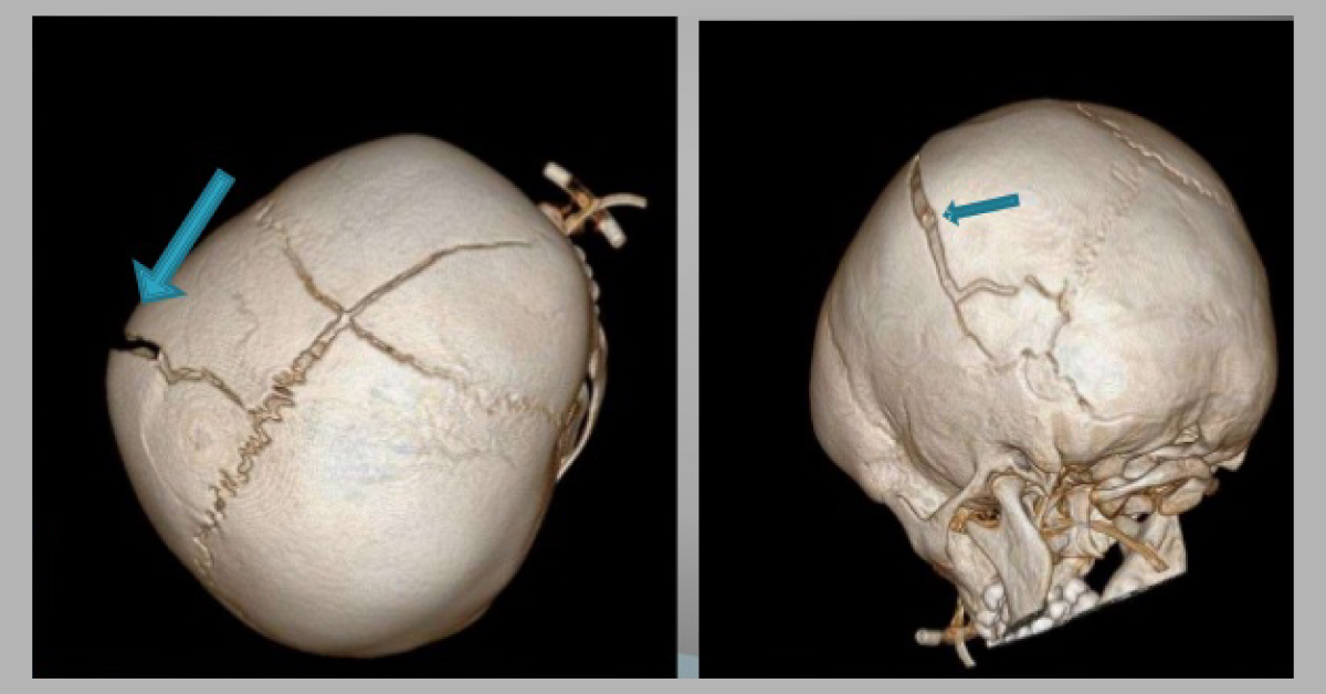 Differentiating Skull Fracture And Accessory Suture In Pediatric Patients