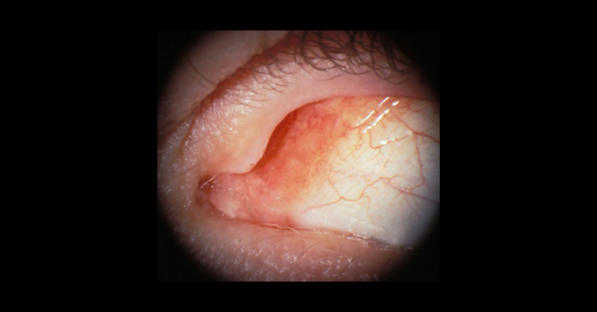 Ophthalmology, Spot Diagnosis