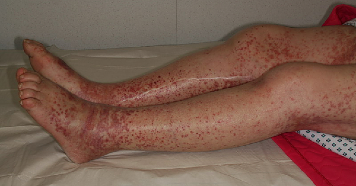 Spot This Hematological Condition