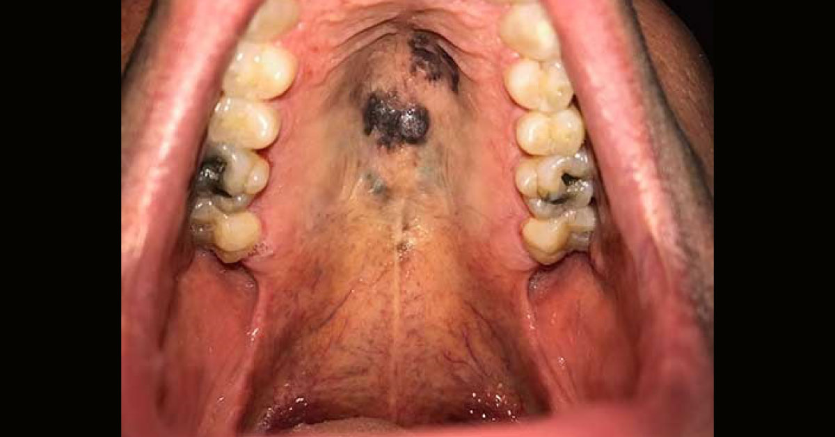 Solve This Case Of Black Palate