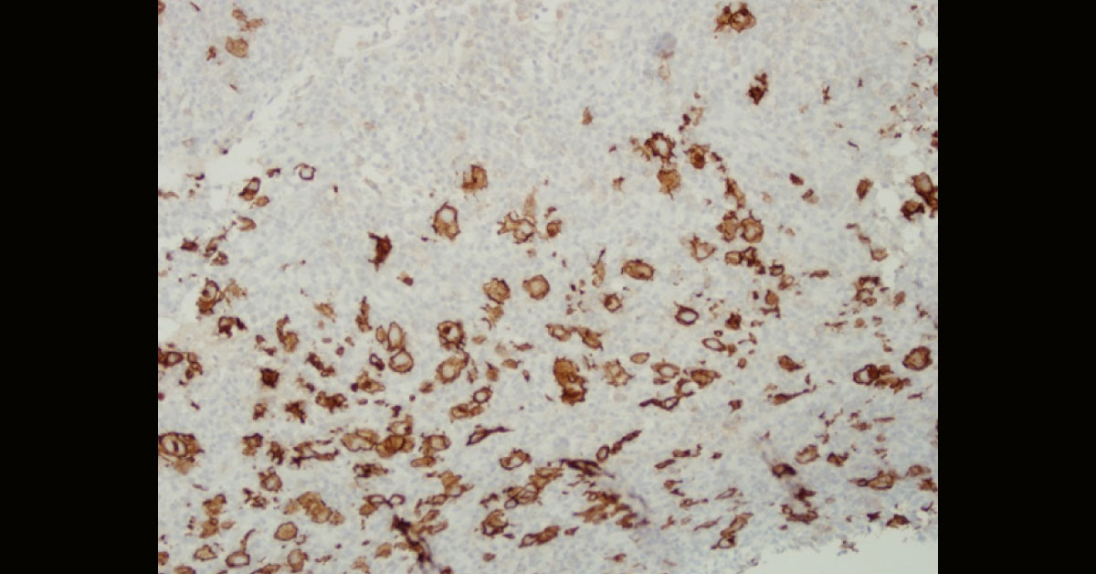 A Case of Iron Deficiency and Abdominal Pain