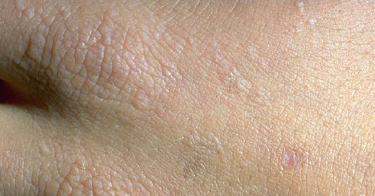 Social Effects Of Erythropoietic Protoporphyria