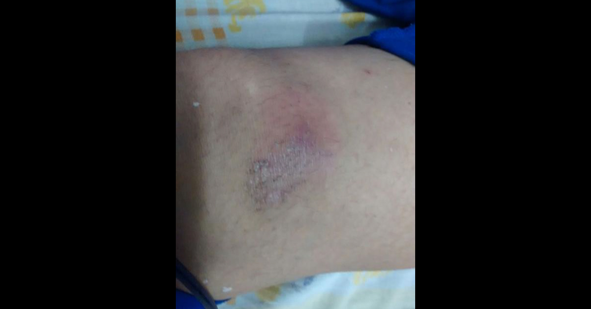 Itchy Skin With Pain