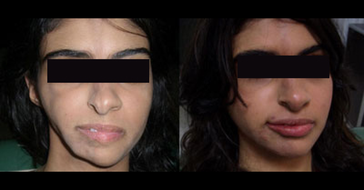 Orthognathic Surgery, General Recommendations