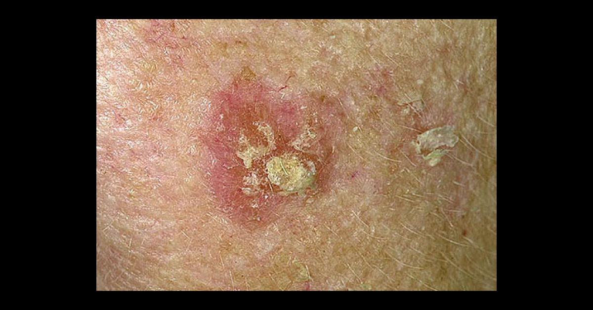 What is this dermal condition