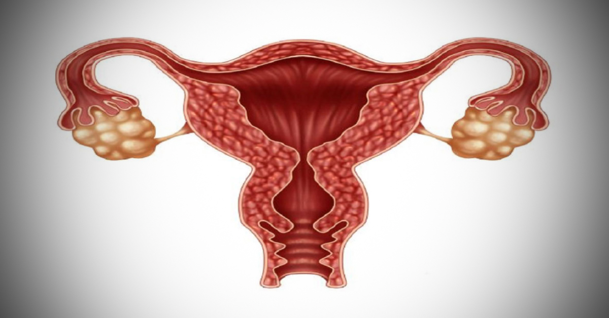 Bottlenecks in PCOS Management