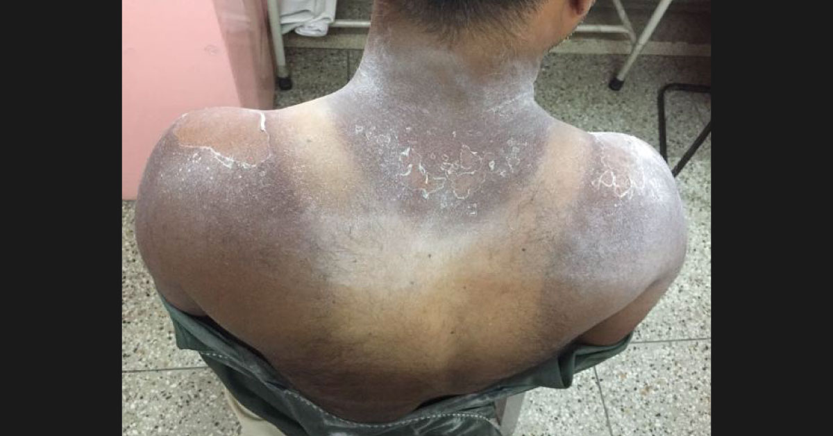 Diagnose The Dermal Condition