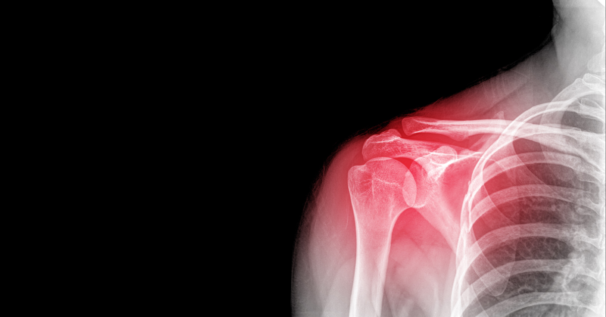 Evaluating Proximal Humerus Fractures