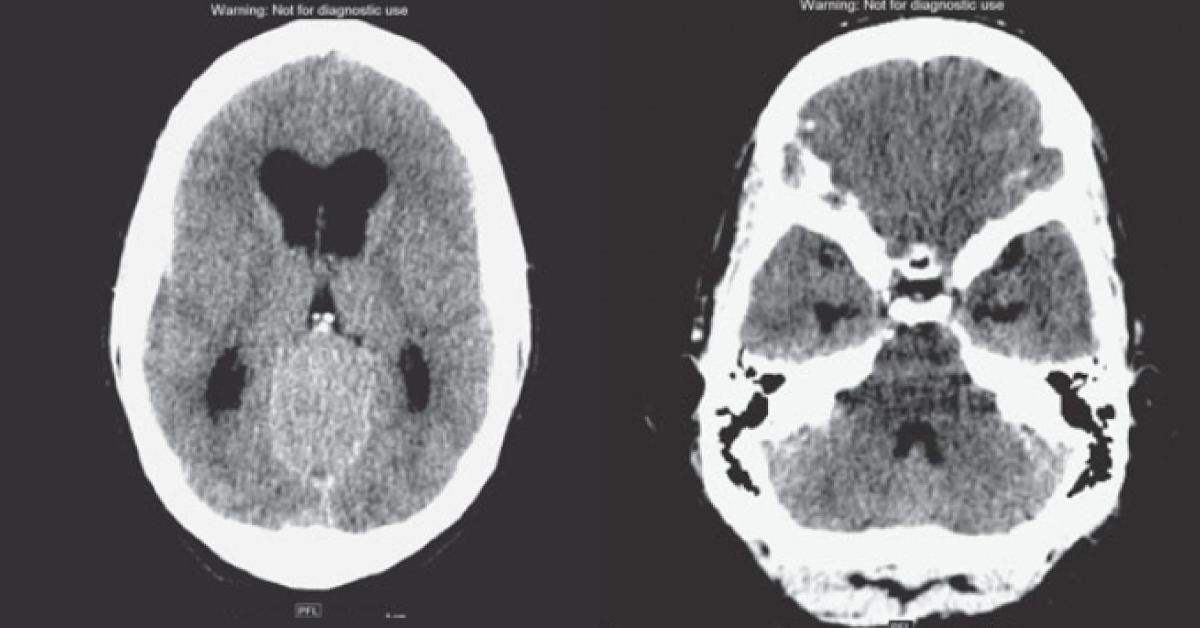 Solve This Case Of Chronic Headache