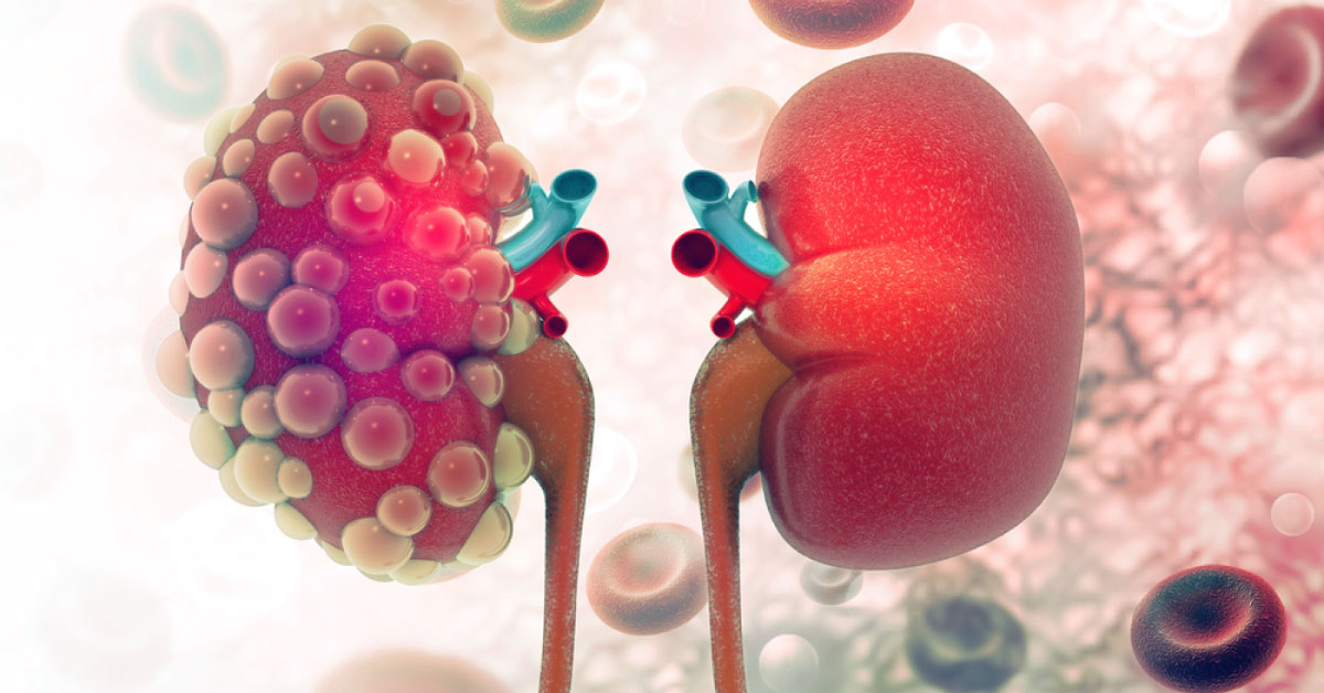 Acute Kidney Injury In Cancer Patients, Diagnosis And Treatments