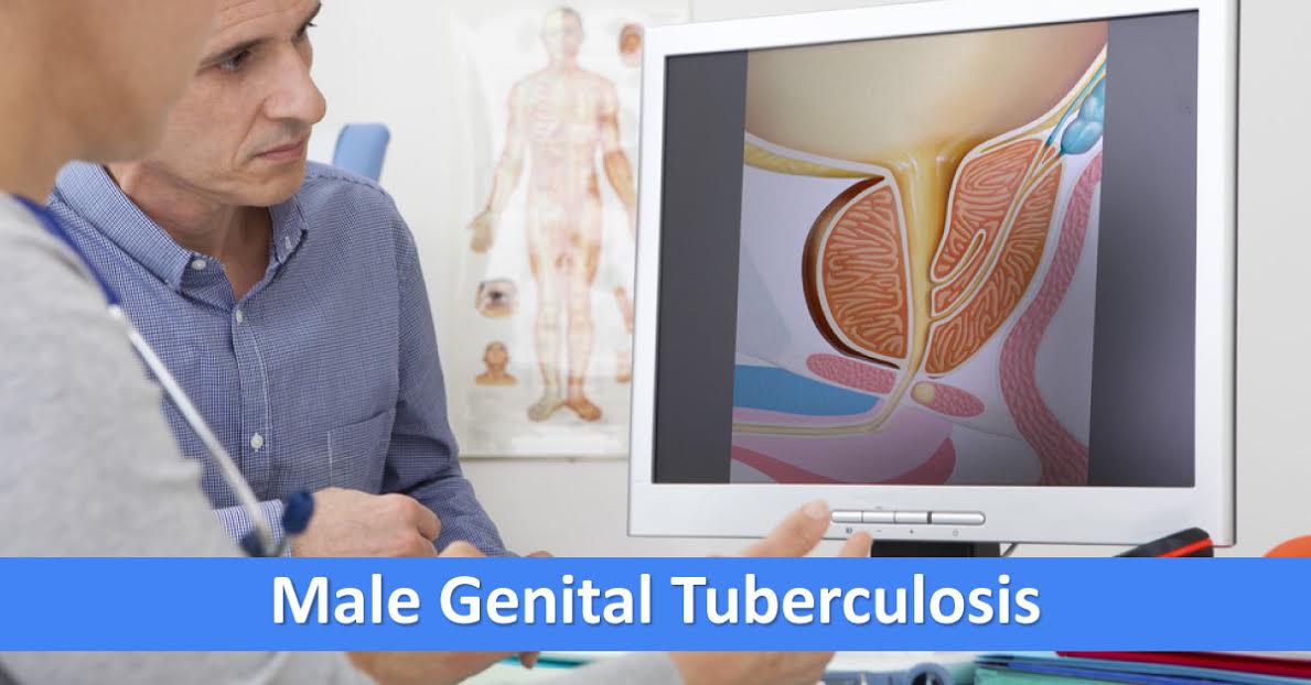 Male Genital Tuberculosis, An Insight