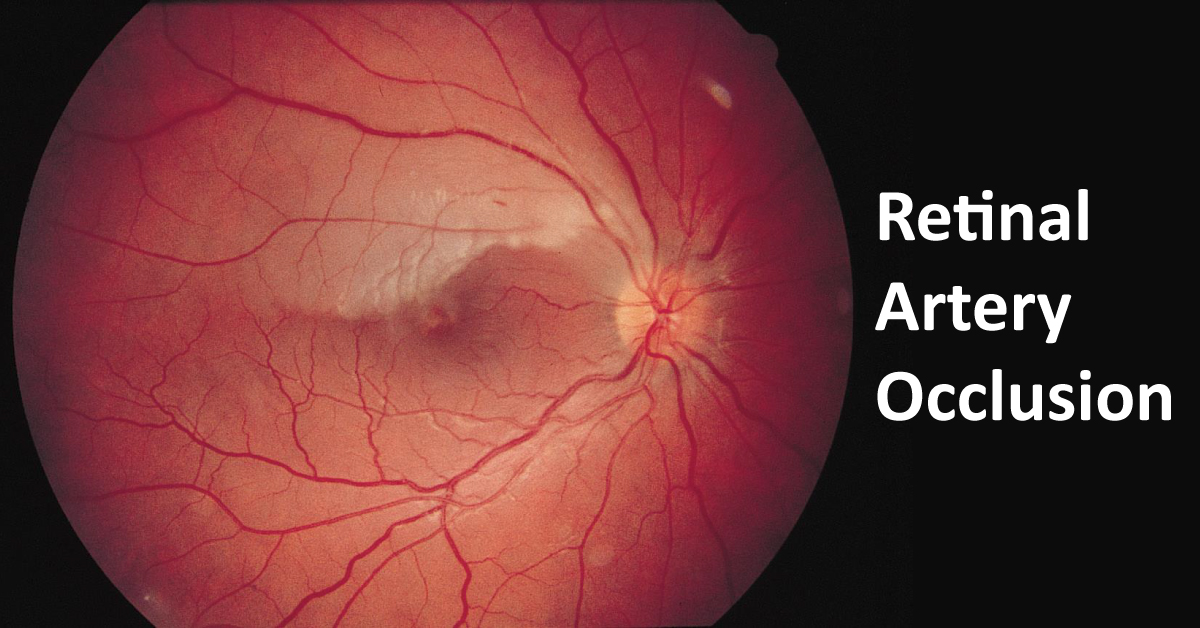 Management Of Retinal Artery Occlusion