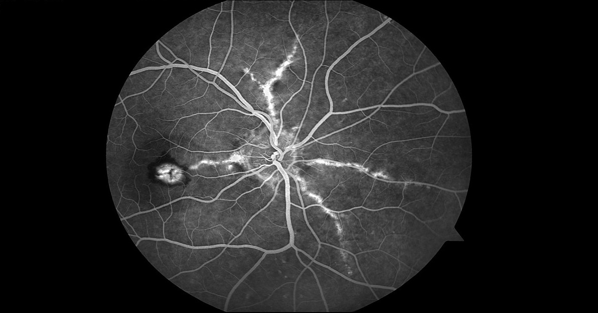 Angioid Streaks, Treatment And Management