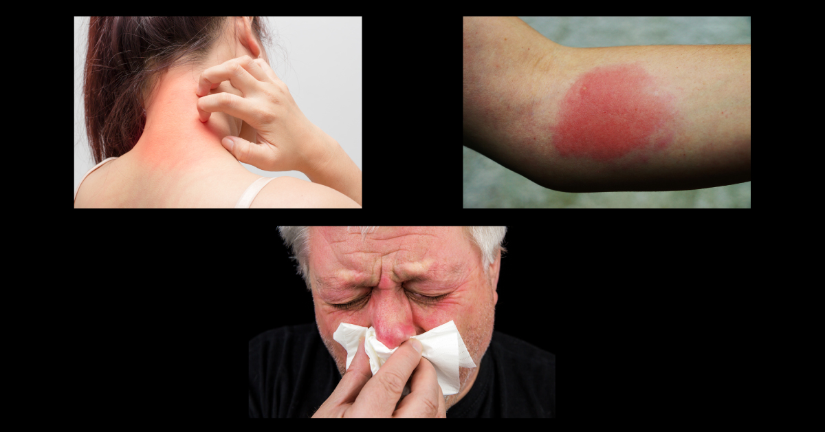 Management Of Acute Allergic Reactions