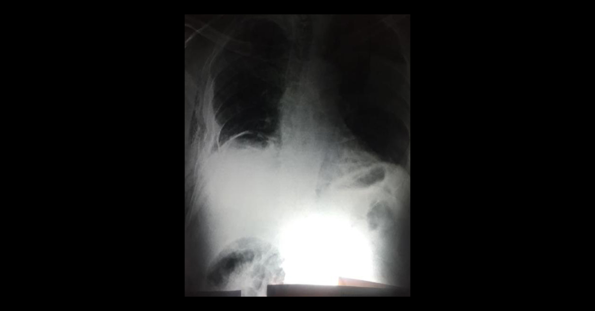Explain How Did The Air Entered Under The Diaphragm