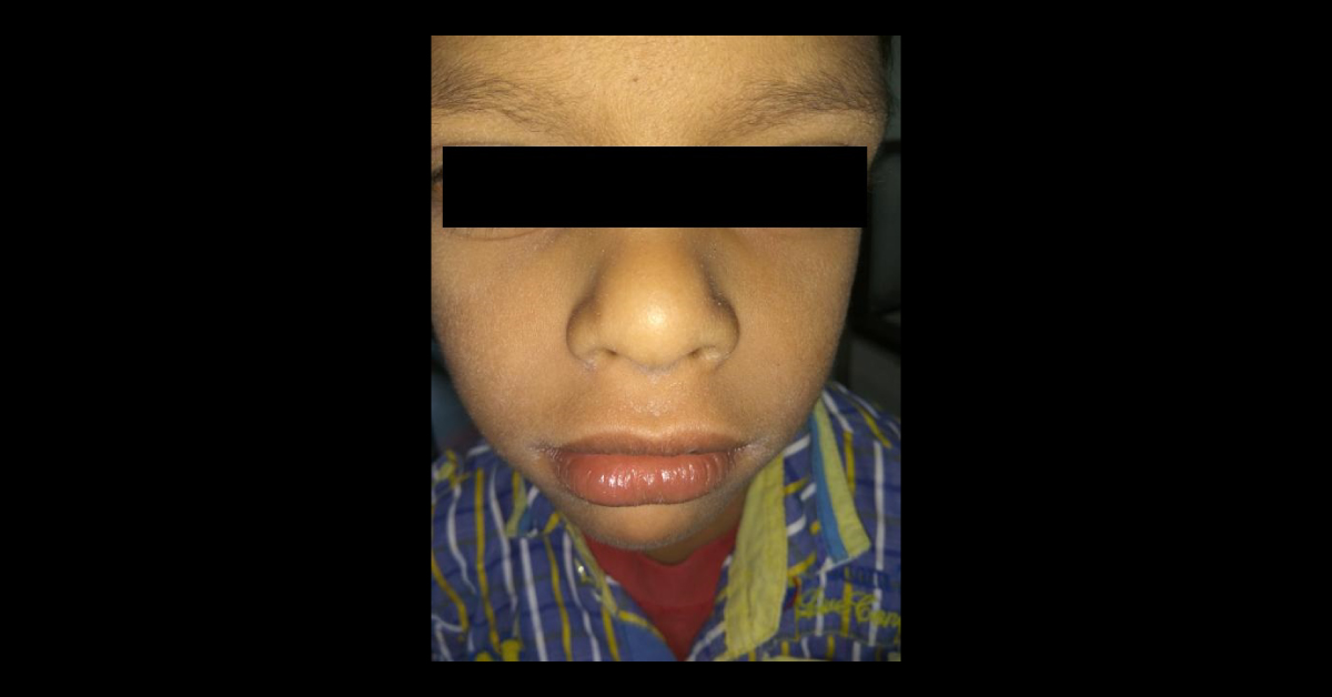 Identify This Pediatrics Condition