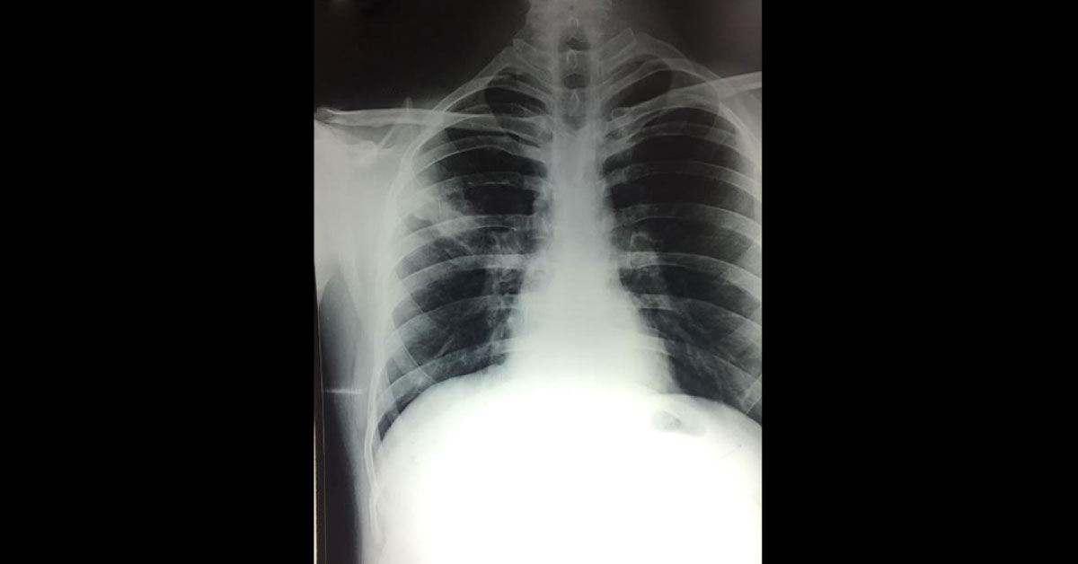 Wanted Diagnosis Through X-ray Chest Only