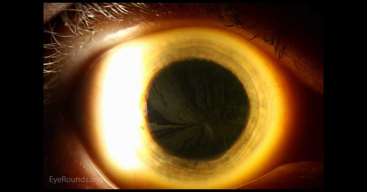 Spot The Ophthalmic Condition