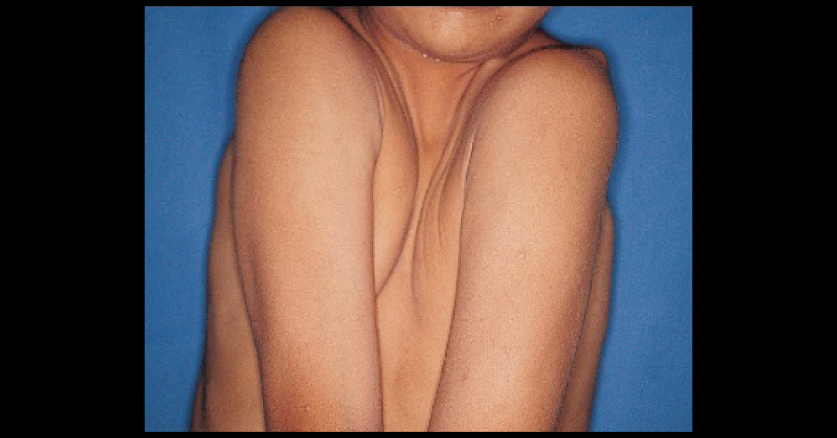 A Case Of High Arched Palate
