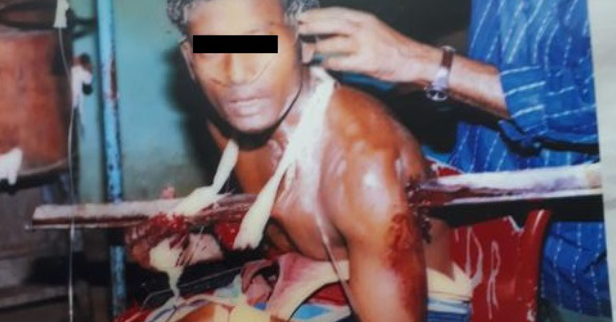 Penetrating Injury To Left Chest