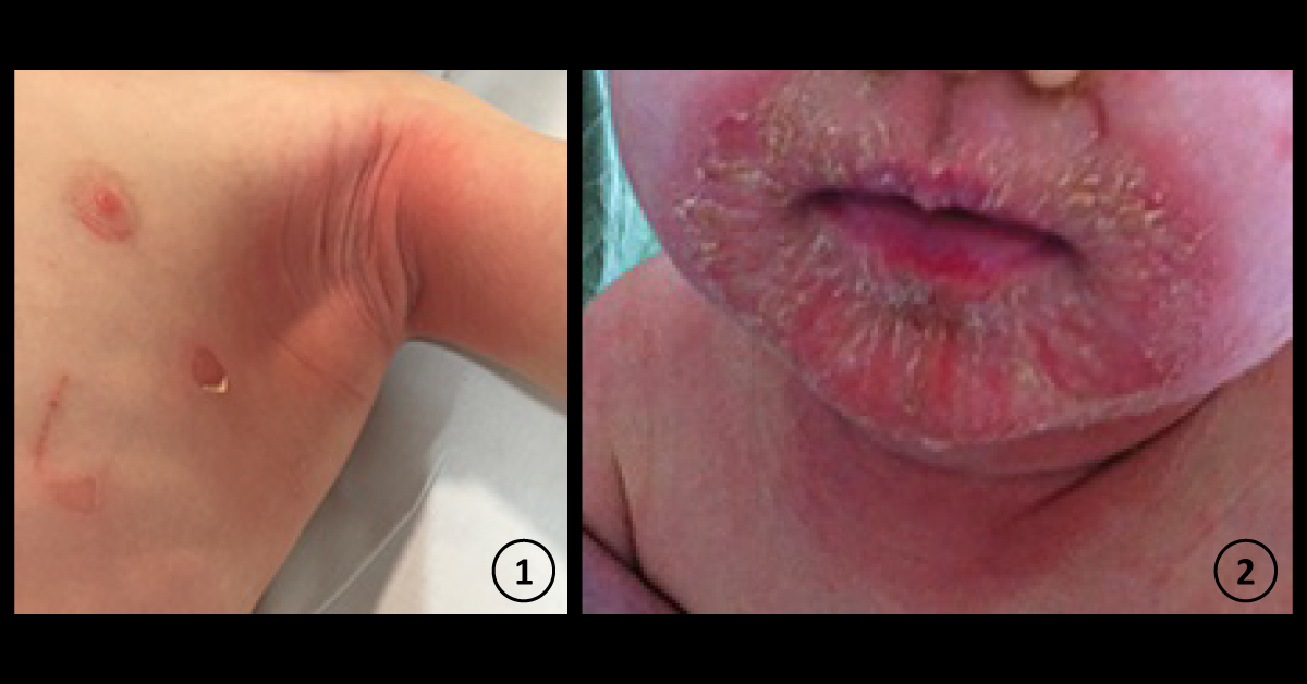 Identify This Case Of Erythematous Skin Eruption