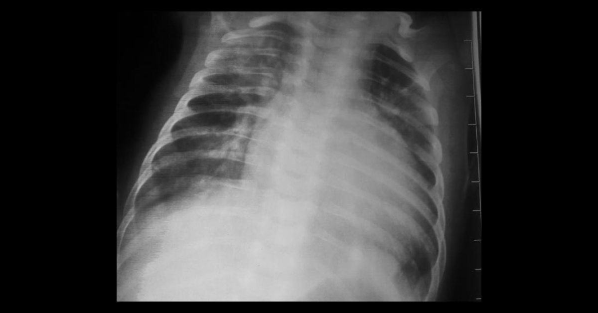 Newborn With Cyanosis