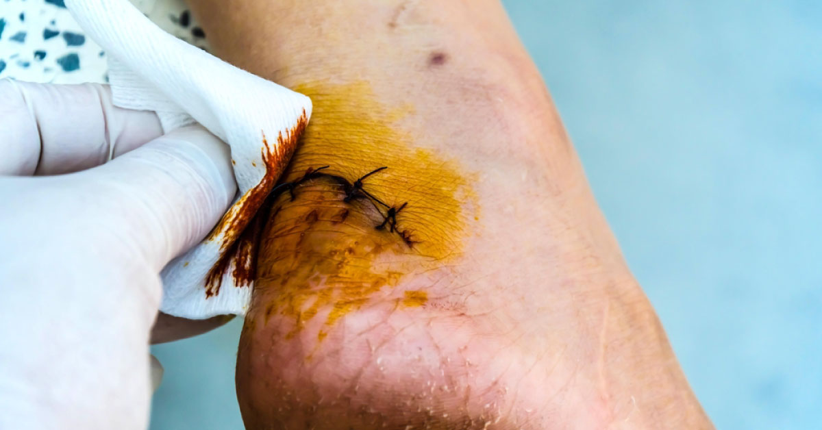 Preventing Surgical Site Infections