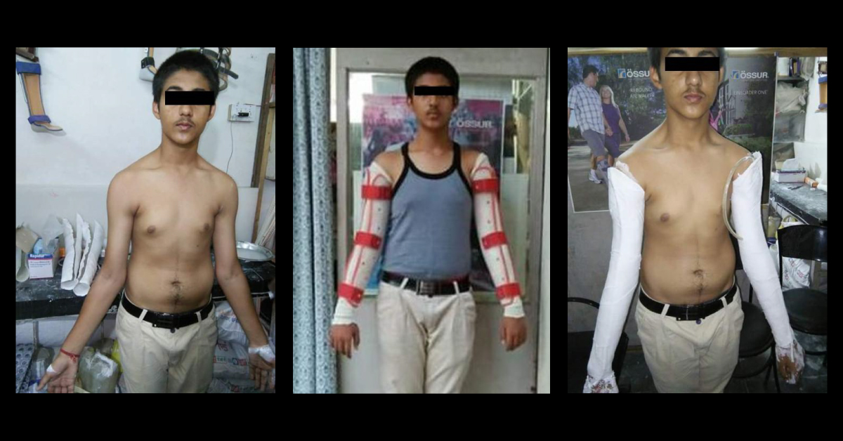 Cubitus Valgus And Its Orthotic Management