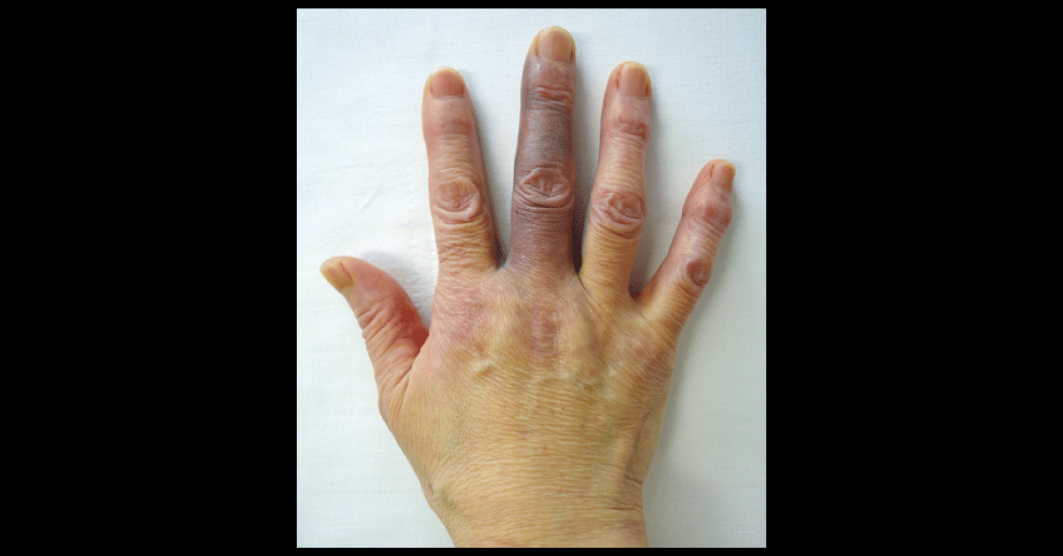 Sudden Onset Of Pain And Bruising Of The Middle Finger