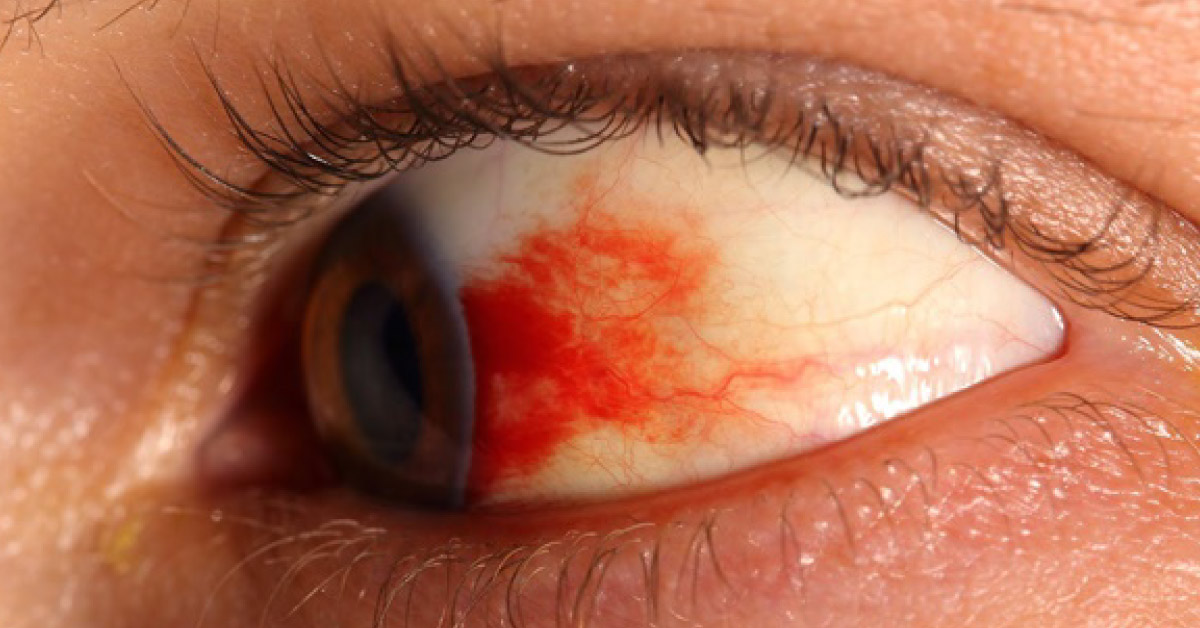 Hydroxychloroquine Induced Retinopathy