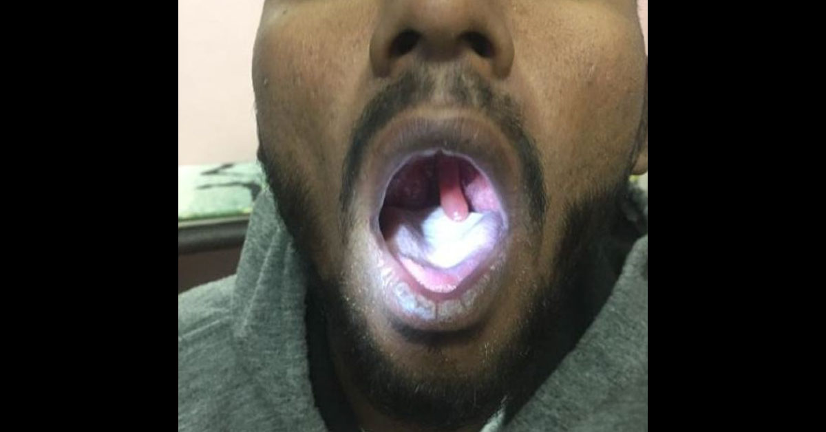 Long Uvula Problematic Or Normal