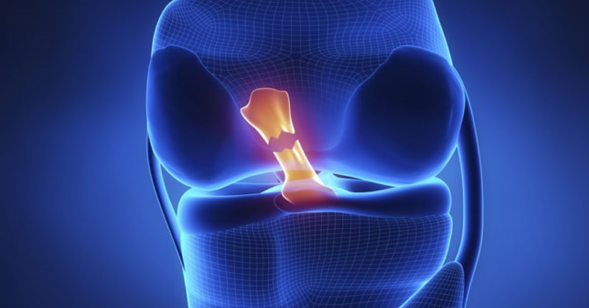 Perioperative Recommendations For ACL Reconstruction
