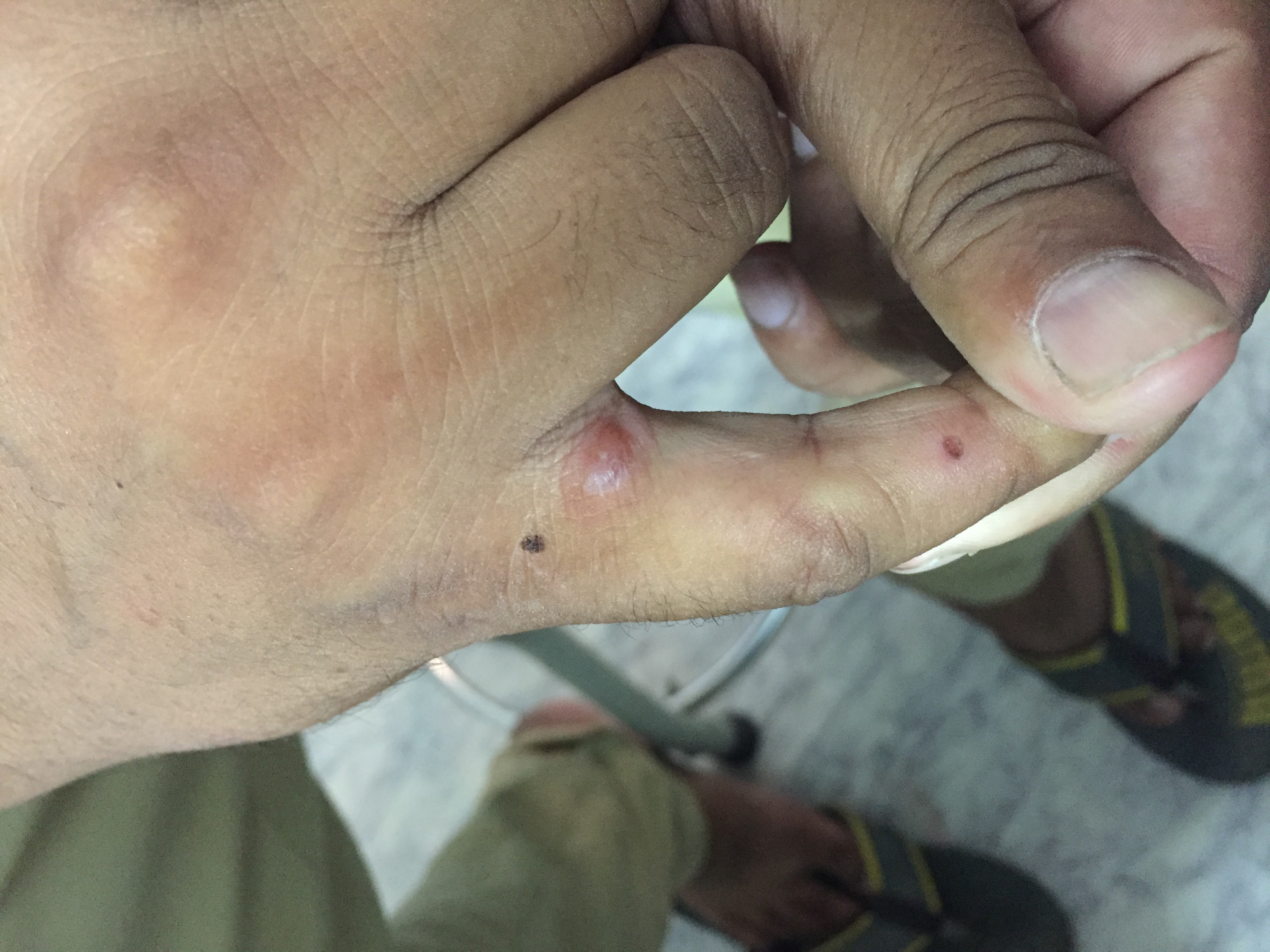 Water Blisters On Hands And Arms