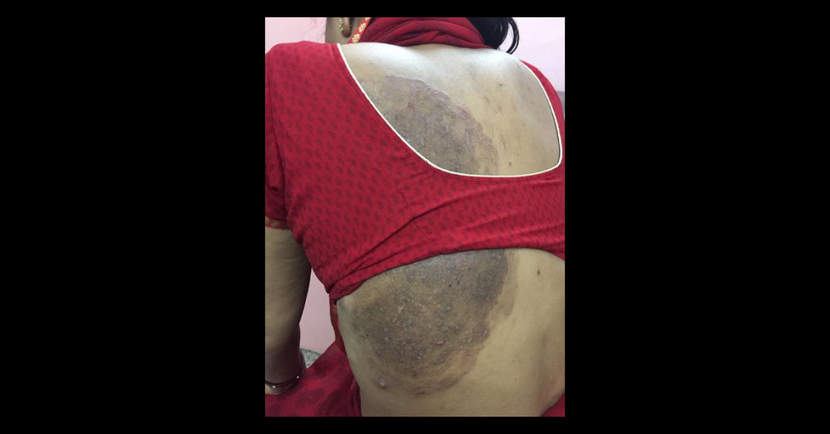 What Is This Skin Lesion? 