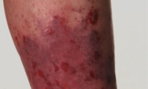 Diagnose this dermatological case
