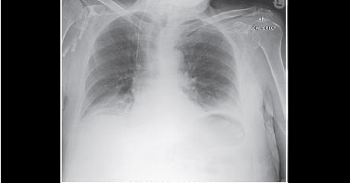 Postoperative Pyrexia In A Male