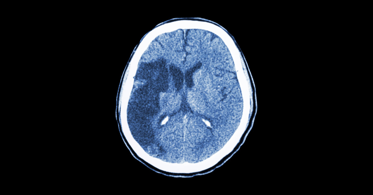 Ischemic Stroke - Without Heparin Protocol