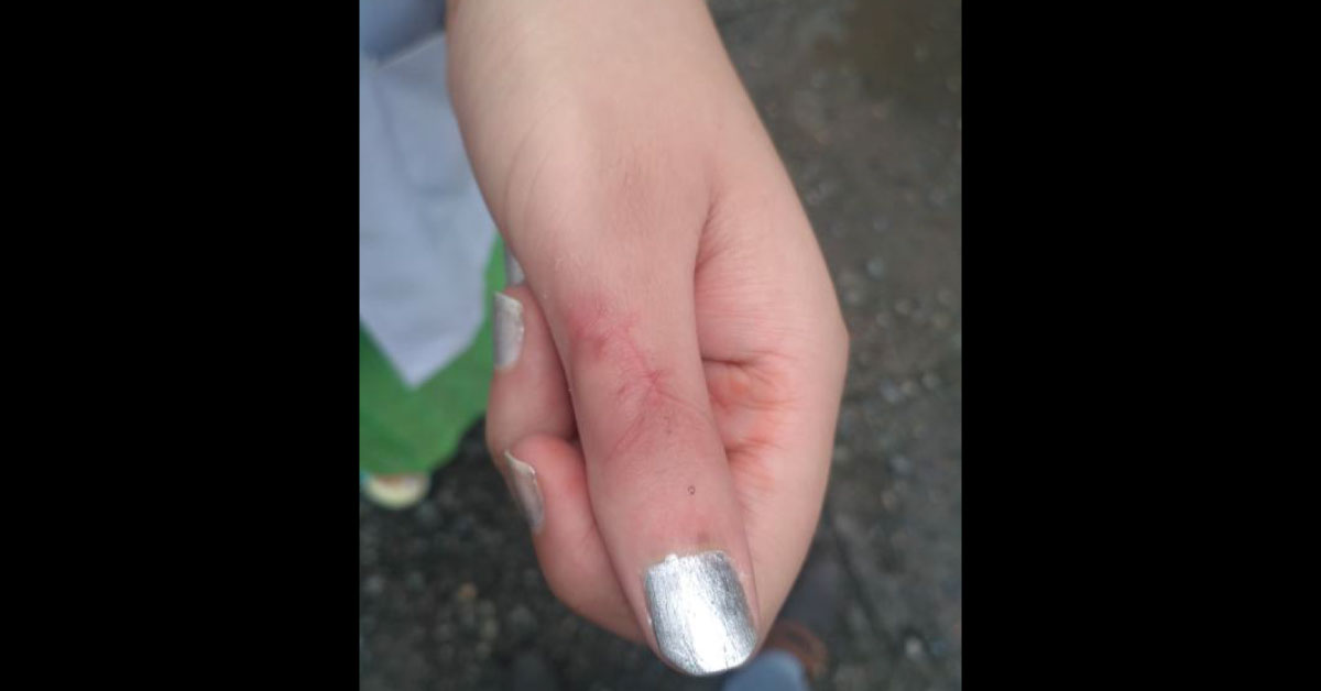 Treatment For Frozen Thumb