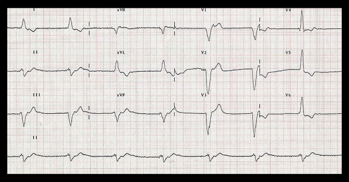 Diagnose The Condition From The ECG